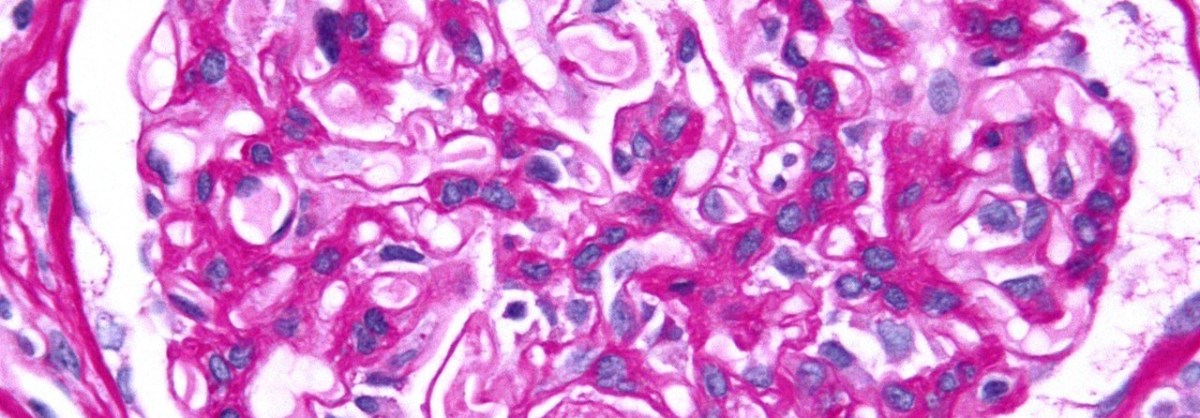 Episode 19: (Why) does DIC cause&nbsp;shock?