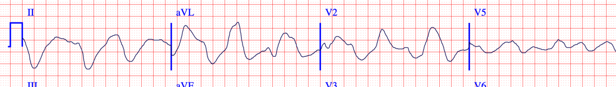 Episode 26: Why do we give calcium in&nbsp;hyperkalemia?