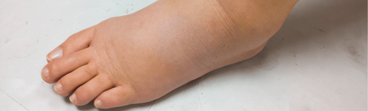 Episode 31: Why does nephrotic syndrome cause&nbsp;edema?