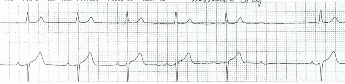 Episode 52 – Way Back&nbsp;Wenckebach