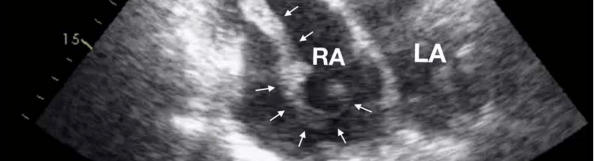 Episode 68 – A fib about&nbsp;PE