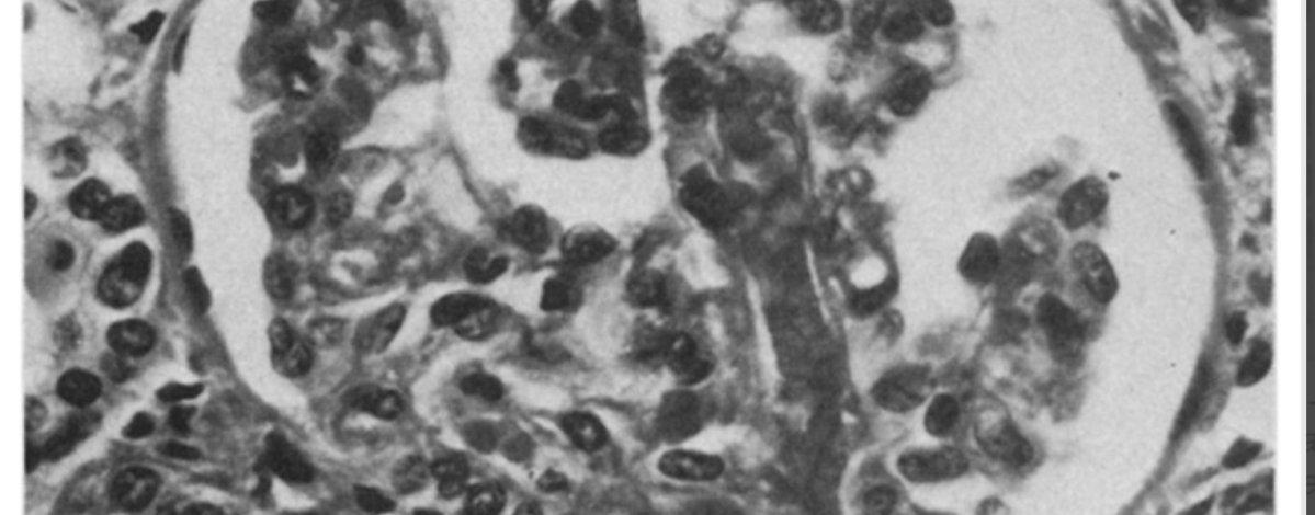 Episode 80 – A Scleroderma&nbsp;Crisis