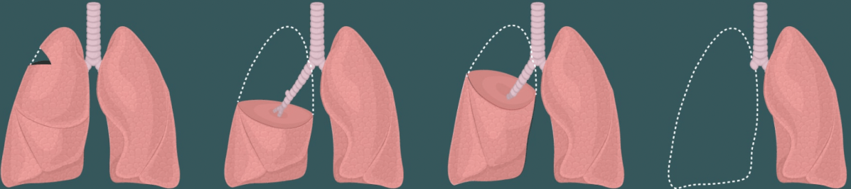 Episode 99 – Living on a&nbsp;Lung