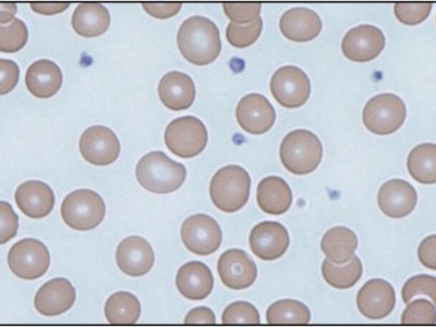 Episode 129: Ironing Out More&nbsp;Platelets