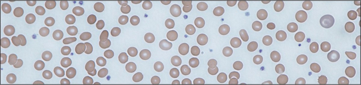 Episode 129: Ironing Out More&nbsp;Platelets